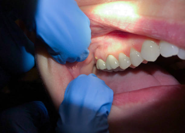 Best Emergency Treatment for Toothache in Hawkinsville, GA